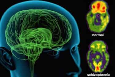 schizophrenia-treatment